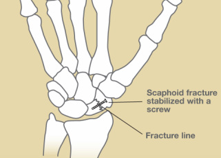 Omaha scaphoid fracture