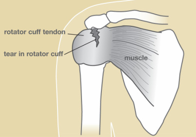 Rotator Cuff Tear - Hand Wrist Elbow Surgeon: Izadi Orthopedics: Omaha Ne