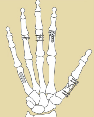 Omaha hand fracture
