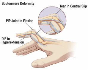 How to Tape a Jammed Finger: Step-by-Step Guide | BraceNation