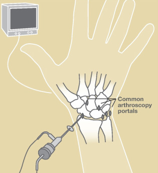 Omaha Wrist arthroscopy