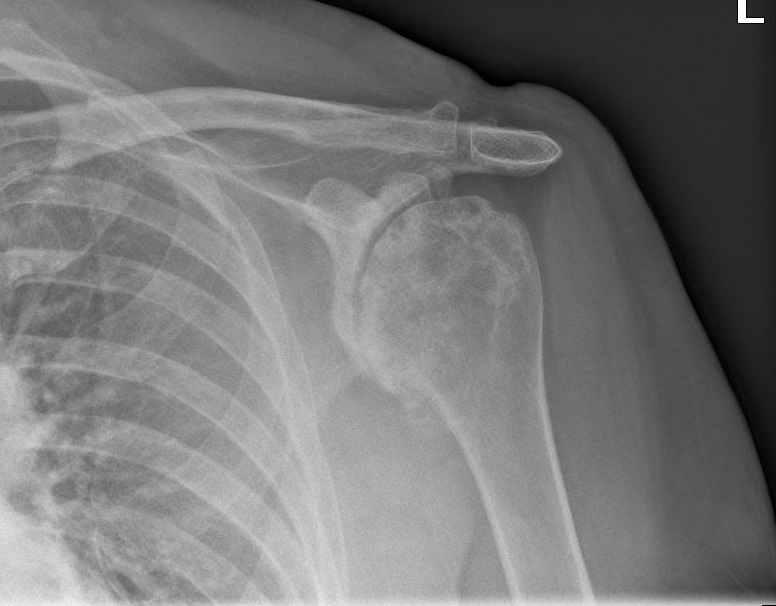 Shoulder Arthritis - KAYVON IZADI MD | HAND WRIST ELBOW ORTHOPEDIC SURGEON